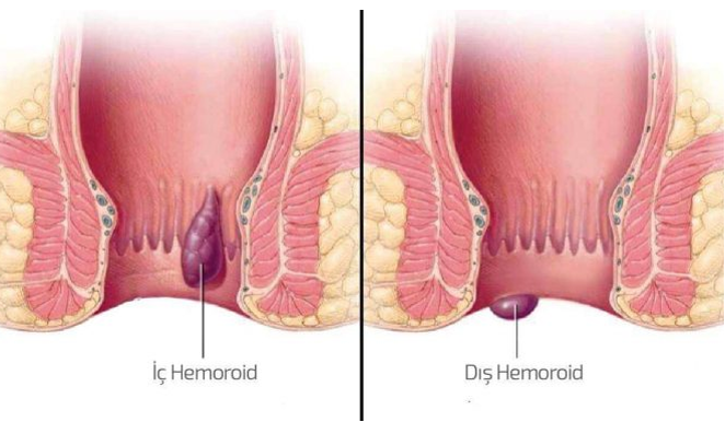Hemoroid Belirtileri Nedir?